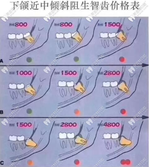 不同智齒拔除價(jià)格
