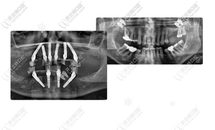 用德國sky種植體做全口即刻負重種植牙怎么樣，價格如何？
