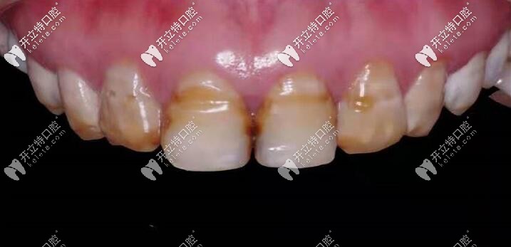四環(huán)素牙做10顆納米水晶瓷貼面美白的效果太讓人出乎意料啦