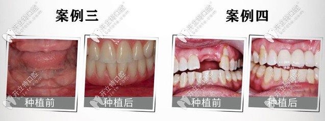 德國ICX種植牙案例