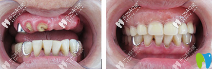 黃宏院長(zhǎng)種植案例