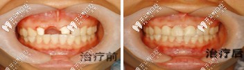 惠安齒科種植牙前后對比