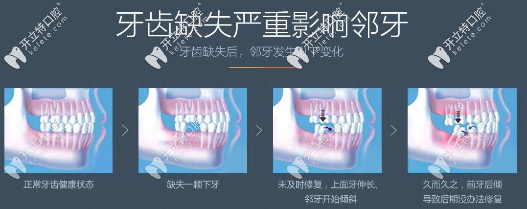 牙齒缺失的后果