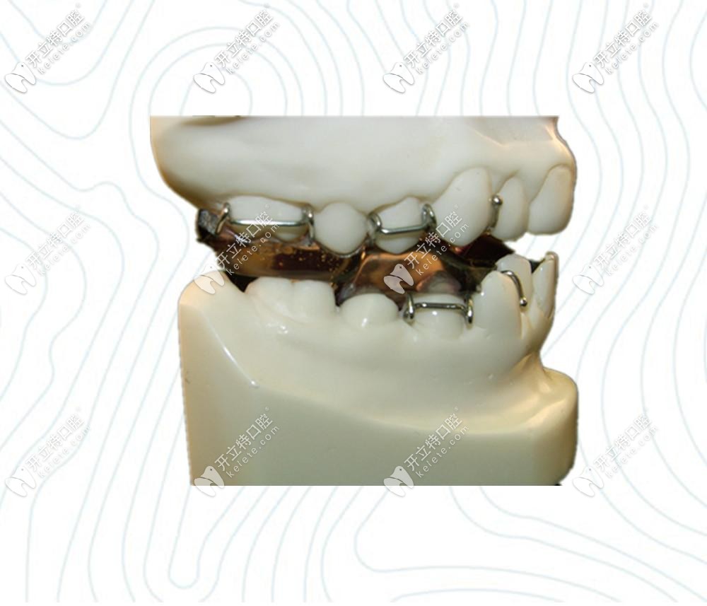 快來看看twinblock矯治原理，這些注意事項可是很重要哦！