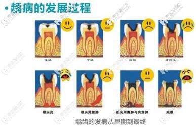 齲齒發(fā)展過程