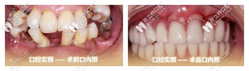 種植牙前后對(duì)比