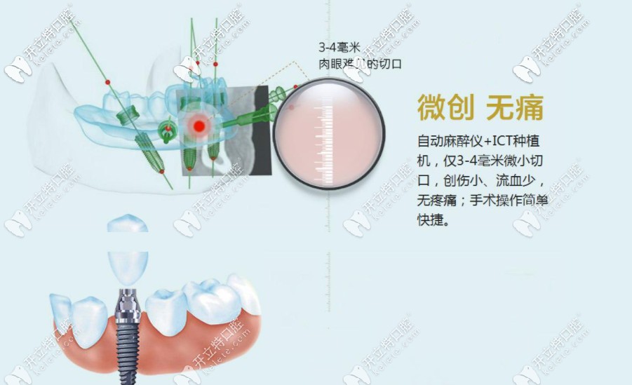 微創(chuàng)種植