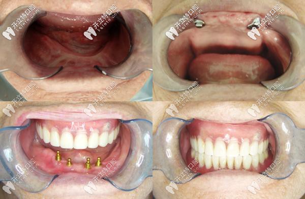 咸陽(yáng)海濤口腔ALL-on-4全口種植