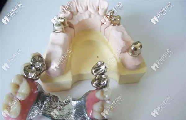 套筒冠義齒修復示意圖