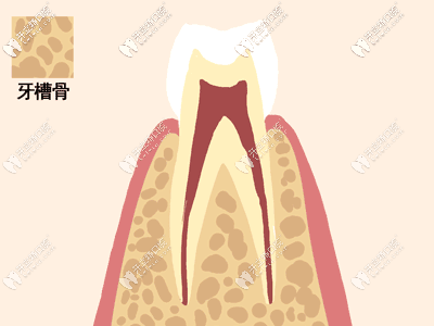 牙周炎發(fā)展的過(guò)程