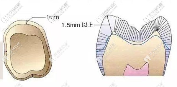 備牙肩臺(tái)是什么意思呢