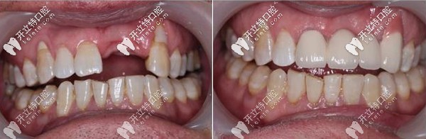 咸陽(yáng)海濤口腔多顆種植牙