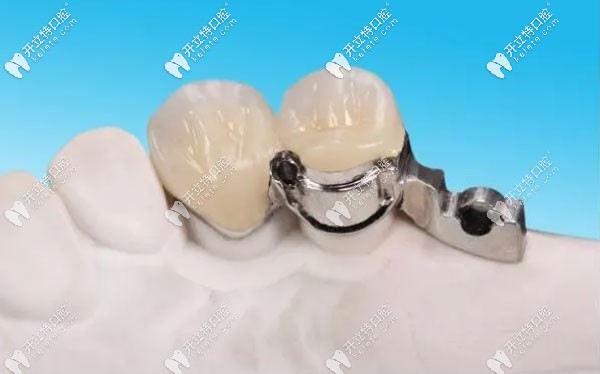 精密附件在牙模上的示意圖