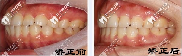 矯正前后對比