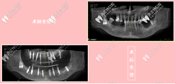 陳先生術(shù)前術(shù)后全景對(duì)比圖