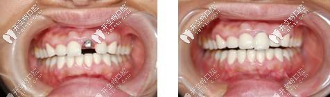 咸陽(yáng)海濤口腔單顆種植牙