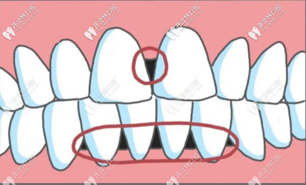 牙齒二級(jí)松動(dòng)黑三角