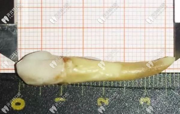 人的智齒較長有幾厘米，3.72厘米的牙齒你見過嗎？