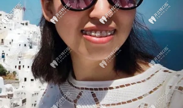 關(guān)于牙套臉的問題我來說說自己的看法