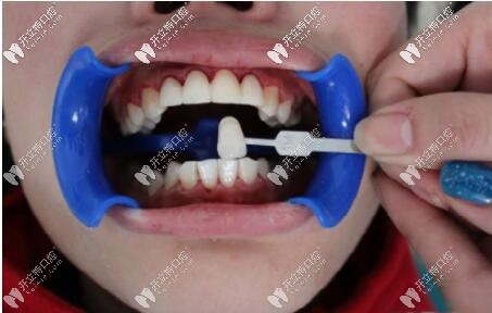 牙齒修復(fù)比色