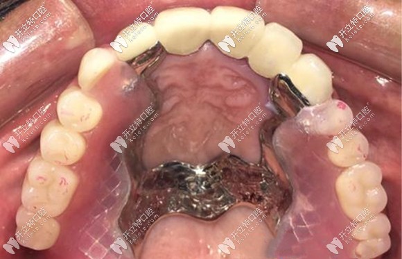 套筒冠和精密附件為什么很少有人做了,是效果不佳嗎？