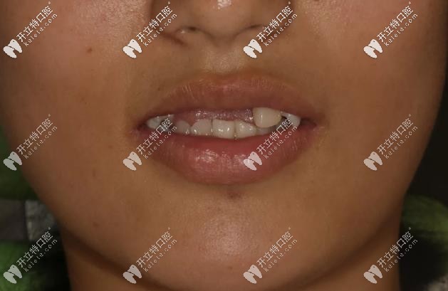 19歲<!--<i data=20240703-sp></i>-->生-摔斷4顆門牙、缺牙四年