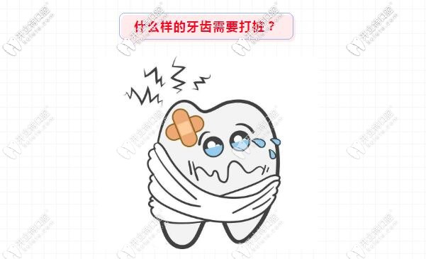  牙齒打樁選什么材料好?纖維樁和金屬樁的區(qū)別是啥