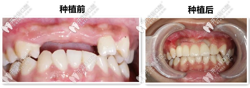 種植牙前后對比圖