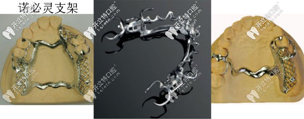 美國諾必靈支架假牙支架
