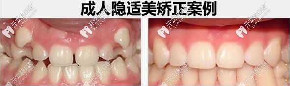 28歲顧客隱適美牙齒矯正前后