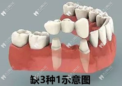 缺牙3顆種1的示意圖
