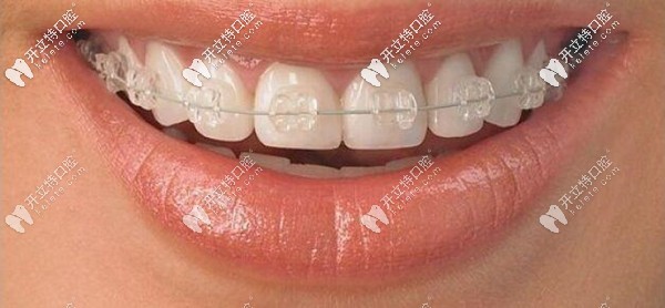半隱型陶瓷矯正器費用