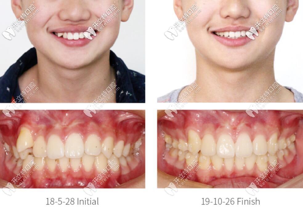 達芬奇雙膜牙套矯正深覆合的案例