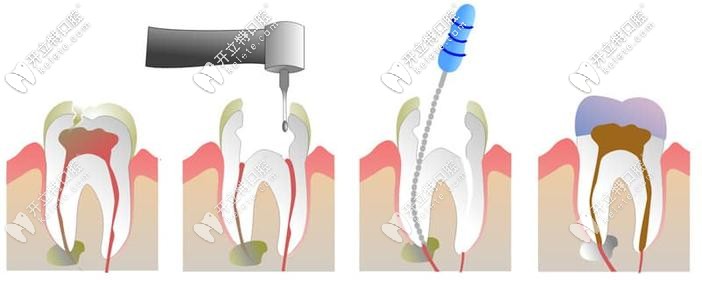根管治療過(guò)程