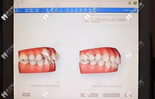 福斯曼隱形牙齒矯正靠譜嗎