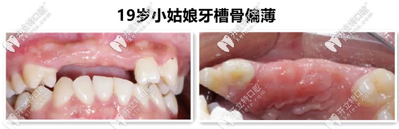 牙槽骨不足，需要植入骨粉