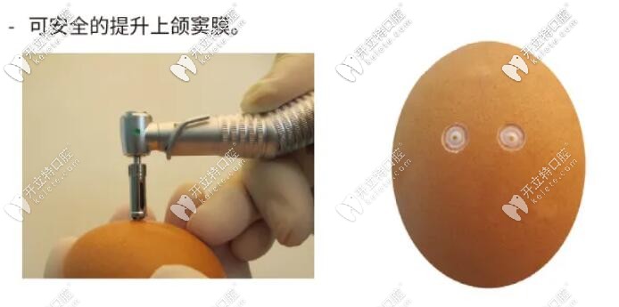 奧齒泰CAS選的安全性