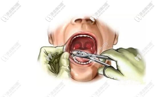 微創(chuàng)拔牙步驟