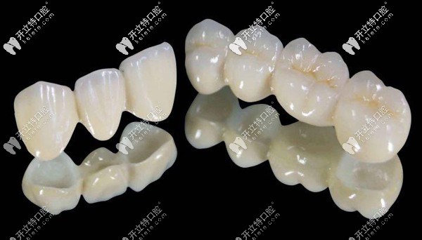 樂瓷全瓷牙價格是多少，怎么辨別德國樂瓷牙冠真假呢？