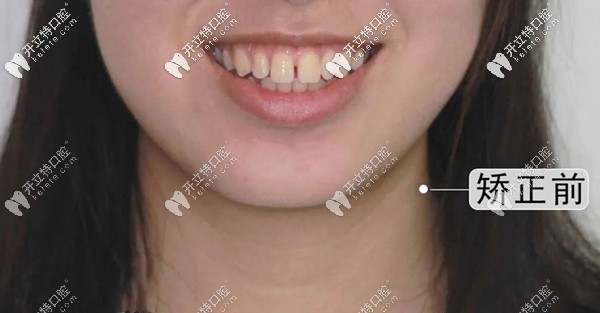矯正前的牙齒圖