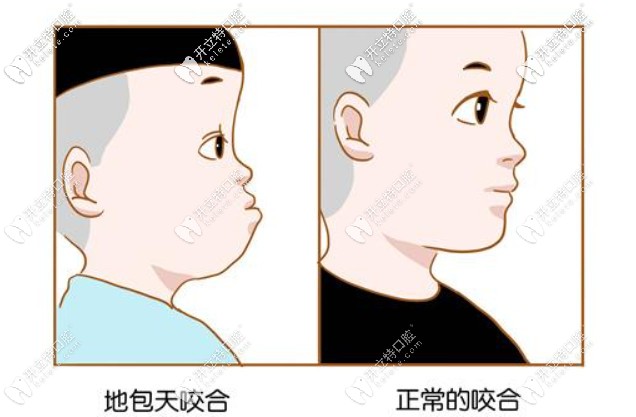 牙齒地包天有必要治嗎？哪個年齡階段矯正比較好