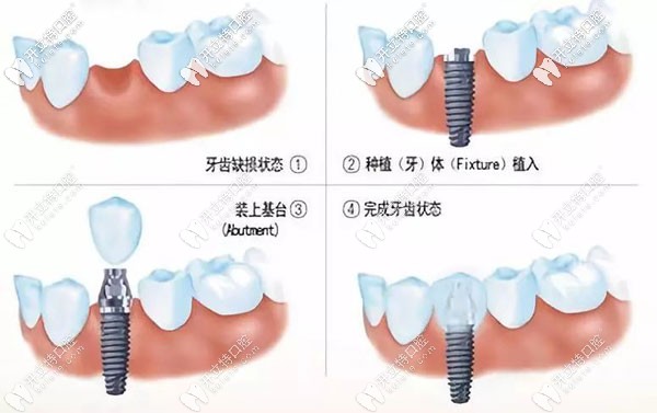 種植牙前需要注意哪些呢？