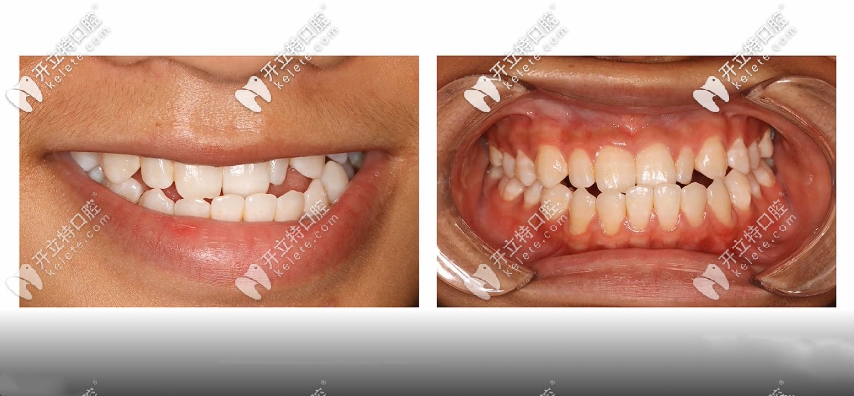 骨性三類凸嘴圖片