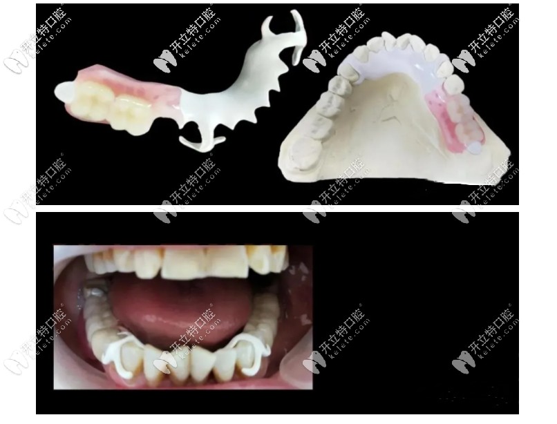 hpp支架義齒案例