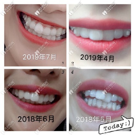 回憶自己門(mén)牙重疊錯(cuò)位,在重慶戴時(shí)代天使隱形牙套矯正效果