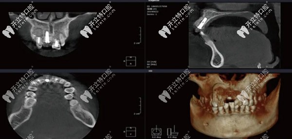 種植奧齒泰植體加植骨