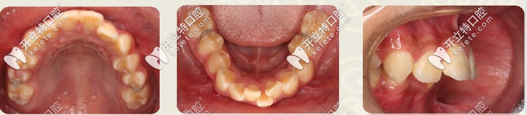 深復(fù)蓋凸嘴伴下巴后縮,直絲弓聯(lián)合擴(kuò)弓,斜導(dǎo)矯正27個(gè)月對(duì)比