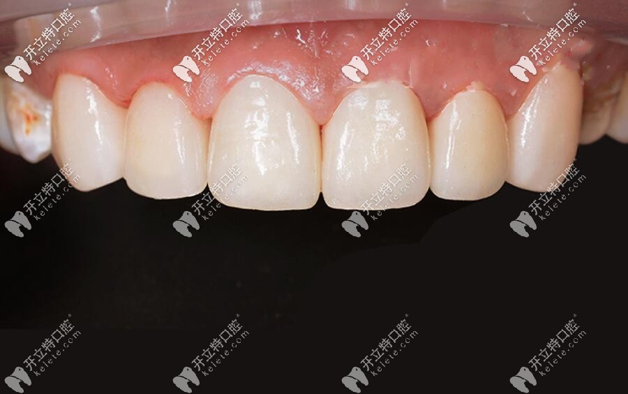 門牙做全瓷牙效果圖
