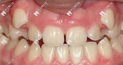 說我是齙牙妹一點都不為過吧