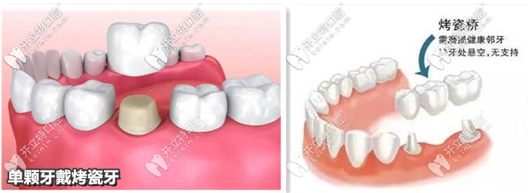 單顆、3連冠烤瓷牙—示意圖